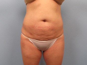 Body Contouring Naples - Mommy Makeover Before