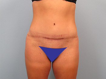 Best Body Contouring Doctor Naples - Mommy Makeover After