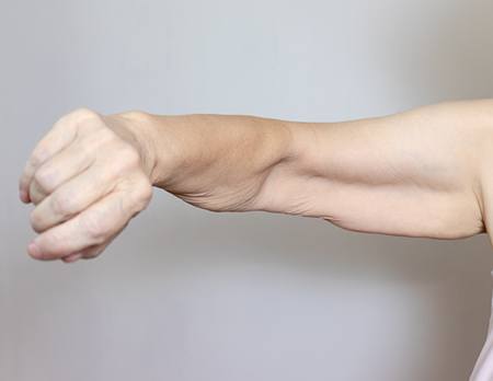 A Photo of An Excess Loose Skin On An Arm Before Arm Lift