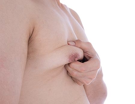 Close up of a man holding his man boobs before Breast Reduction