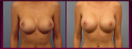 Fort Myers Breast Lift 
Images