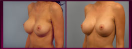 Bonita Springs Breast Lift Images