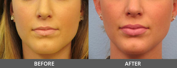 Lip Augmentation Before and After