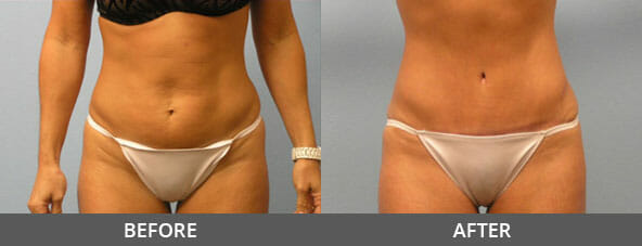 Tummy Tuck Before and After
