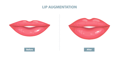 Lip Augmentation diagram