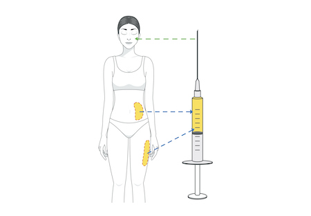 Diagram of woman's body indicating injections in abdomen and thighs