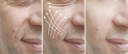 Man's face with arrows indicating reduction of wrinkles