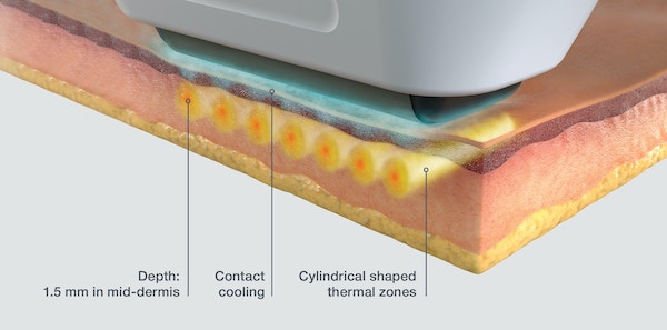 A closeup diagram of the layers of the skin while being treated by Sofwave™