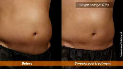 How does SculpSure® Get Rid of Unwanted Body Fat?